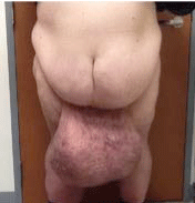 Use Of Panniculus Flap With Delayed Penile Reconstruction For