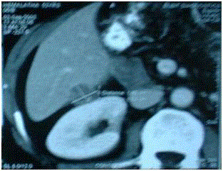 Long Term Survival After Surgery For Ampullary Carcinoma Case Report And Short Review Of Literature