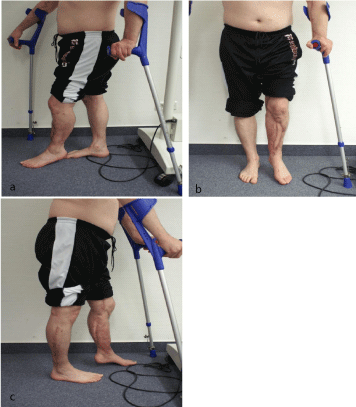 Lower Limb Salvage at any Cost – A Complex Case