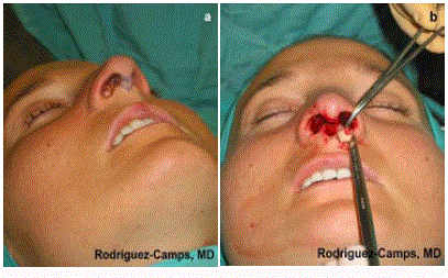 Nasal Rhinotomy Some Less Usual, or Never Used, Technical Resources in Rhinoplasty for ...