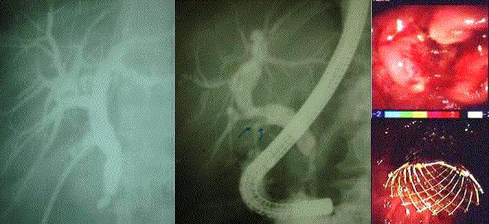 Management of Postoperative Bile Leak: Tertiary Centers Experience